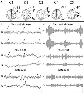 EEG 40 Hz Coherence Decreases in REM Sleep and Ketamine Model of Psychosis